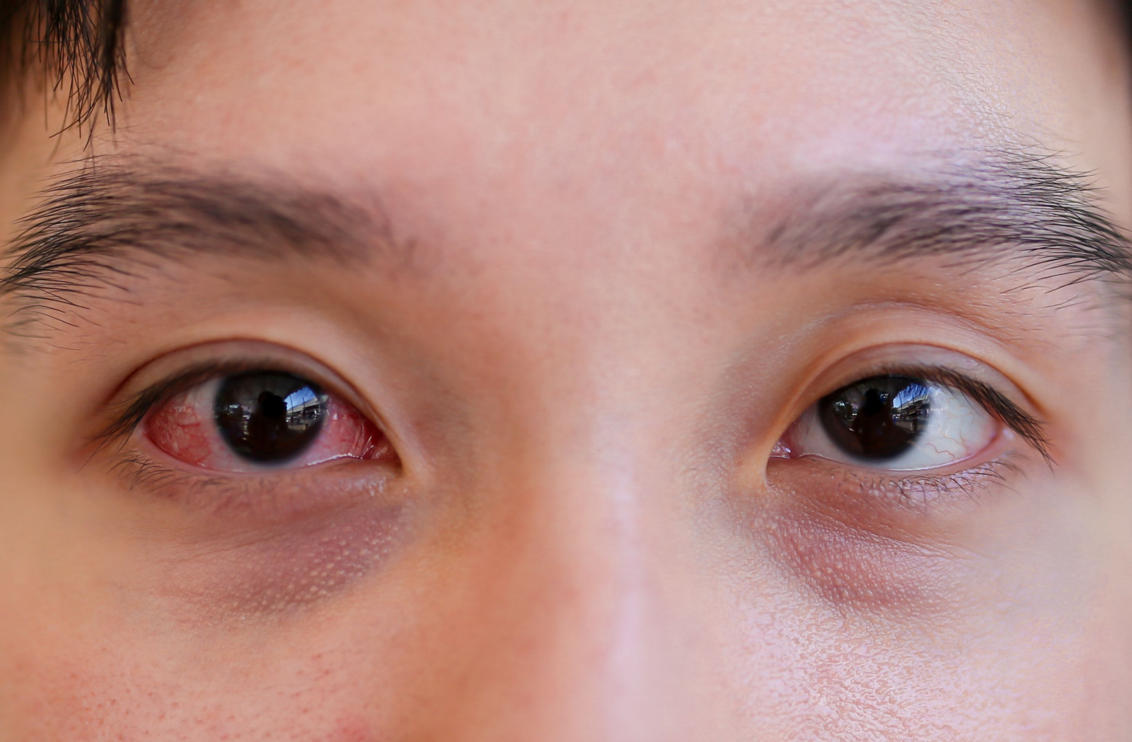 The Common Eye Diseases