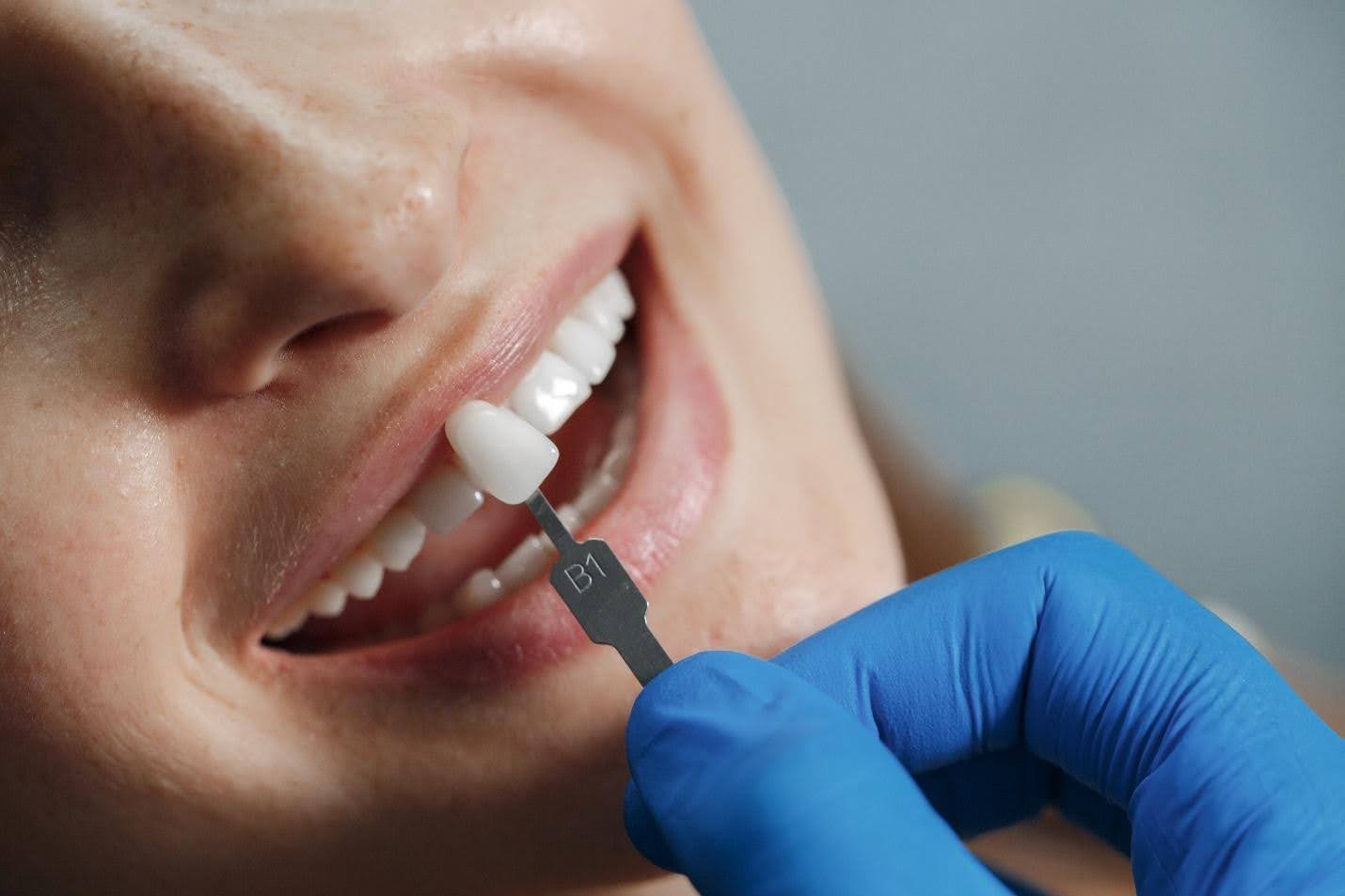 How to Choose the Best Dental Implant Services